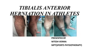 TIBIALIS ANTERIOR
HERNIATION IN ATHLETES
PRESENTED BY
NITESH VERMA
MPT(SPORTS PHYSIOTHERAPY)
 