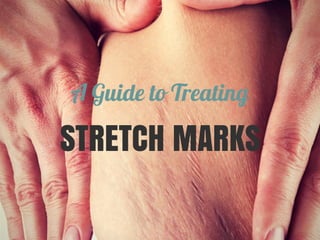 A Guide to Treating 
STRETCH MARKS 
 