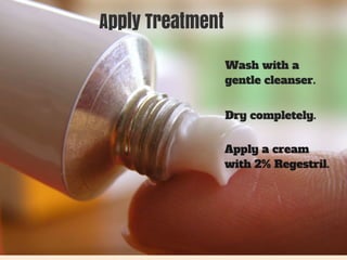Apply Treatment 
Wash with a 
gentle cleanser. 
Dry completely. 
Apply a cream 
with 2% Regestril. 
 