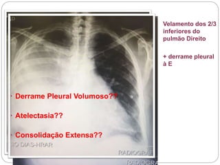 Admissão: 07/07/2017
 Exames
 Radiografia de Torax PA + P
Velamento dos 2/3
inferiores do
pulmão Direito
+ derrame pleural
à E
 Derrame Pleural Volumoso??
 Atelectasia??
 Consolidação Extensa??
 