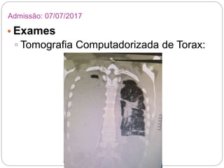 • Exames
▫ Tomografia Computadorizada de Torax:
Admissão: 07/07/2017
 