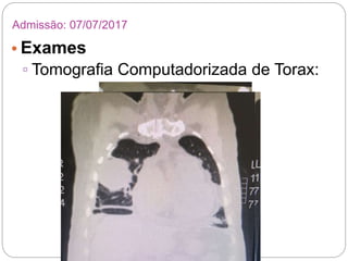 • Exames
▫ Tomografia Computadorizada de Torax:
Admissão: 07/07/2017
 