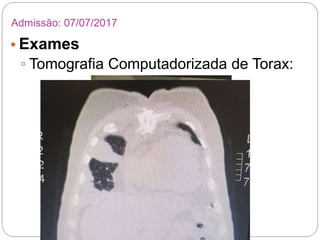 • Exames
▫ Tomografia Computadorizada de Torax:
Admissão: 07/07/2017
 
