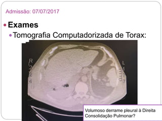  Exames
Tomografia Computadorizada de Torax:
Admissão: 07/07/2017
Volumoso derrame pleural à Direita
Consolidação Pulmonar?
 
