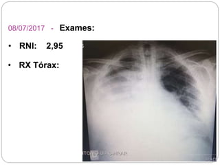 08/07/2017 - Exames:
• RNI: 2,95
• RX Tórax:
 