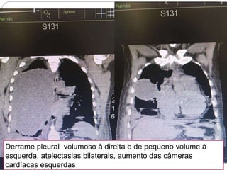  11/07/2017:
 Realizada nova TC de Tórax, discutida com radiologista:
Derrame pleural volumoso à direita e de pequeno volume à
esquerda, atelectasias bilaterais, aumento das câmeras
cardíacas esquerdas
 