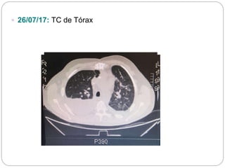 ▫ 26/07/17: TC de Tórax
 