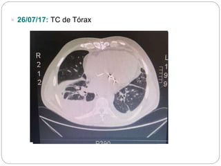 ▫ 26/07/17: TC de Tórax
 