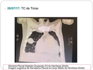 ▫ 26/07/17: TC de Tórax
Derrame Pleural Septado Ocupando 2/3 do Hemitorax Direito.
Imagem sugestiva de Hematoma Pleural em terço Médio de Hemitórax Direito
 