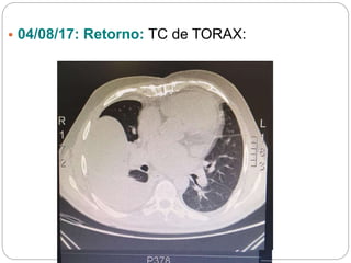 • 04/08/17: Retorno: TC de TORAX:
 