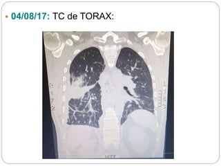• 04/08/17: TC de TORAX:
 