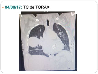 • 04/08/17: TC de TORAX:
 