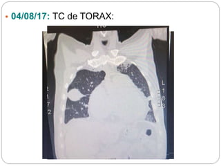 • 04/08/17: TC de TORAX:
 