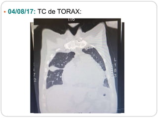 • 04/08/17: TC de TORAX:
 