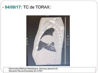 • 04/08/17: TC de TORAX:
Demonstra Melhora Radiológica. Derrame pleural à D.
Derrame Pleural Encistado em HTD?
 
