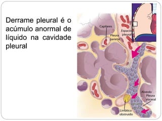 Derrame pleural é o
acúmulo anormal de
líquido na cavidade
pleural
 