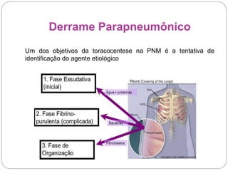 Derrame Parapneumônico
Um dos objetivos da toracocentese na PNM é a tentativa de
identificação do agente etiológico
 