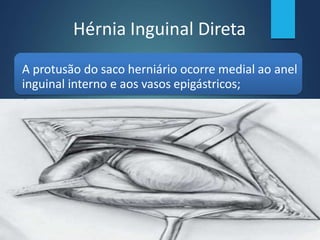 Hérnia Inguinal Direta
A protusão do saco herniário ocorre medial ao anel
inguinal interno e aos vasos epigástricos;
 