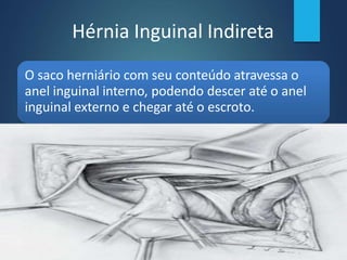 Hérnia Inguinal Indireta
O saco herniário com seu conteúdo atravessa o
anel inguinal interno, podendo descer até o anel
inguinal externo e chegar até o escroto.
 