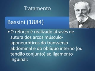 Tratamento
Bassini (1884)
•O reforço é realizado através de
sutura dos arcos músculo-
aponeuróticos do transverso
abdominal e do oblíquo interno (ou
tendão conjunto) ao ligamento
inguinal;
 