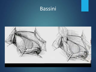 Bassini
 