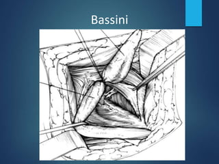 Bassini
 