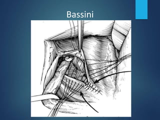 Bassini
 