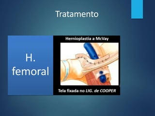 Tratamento
H.
femoral
 