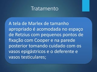 Tratamento
A tela de Marlex de tamanho
apropriado é acomodada no espaço
de Retzius com pequenos pontos de
fixação com Cooper e na parede
posterior tomando cuidado com os
vasos epigástricos e o deferente e
vasos testiculares;
 