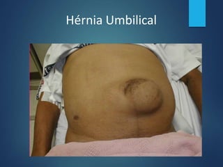Hérnia Umbilical
 
