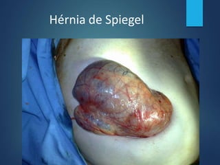 Hérnia de Spiegel
 