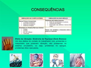 Efeito da vibração: Síndrome de Raynaud (Dedo Branco)
Um dos efeitos do contato do trabalhador com ambientes e
maquinário que possuem vibração, são problemas no
sistema circulatório, ou seja, problemas no sangue,
problemas ditos vasculares.
 