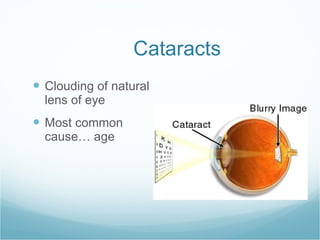 Cataracts Clouding of natural lens of eye Most common cause… age 