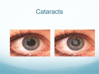 Cataracts 
