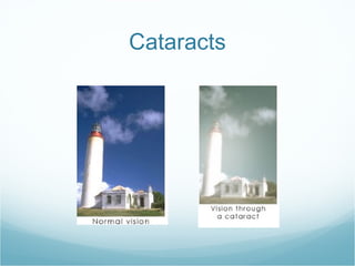 Cataracts 