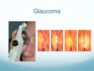 Glaucoma 