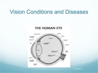 Vision Conditions and Diseases www.opto.ca 