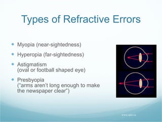 Types of Refractive Errors Myopia (near-sightedness) Hyperopia (far-sightedness) Astigmatism (oval or football shaped eye) Presbyopia (“arms aren’t long enough to make the newspaper clear”) www.opto.ca 