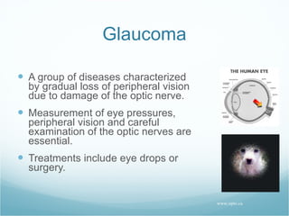 Glaucoma A group of diseases characterized by gradual loss of peripheral vision due to damage of the optic nerve. Measurement of eye pressures, peripheral vision and careful examination of the optic nerves are essential. Treatments include eye drops or surgery. www.opto.ca 