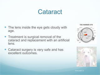 Cataract The lens inside the eye gets cloudy with age. Treatment is surgical removal of the cataract and replacement with an artificial lens. Cataract surgery is very safe and has excellent outcomes. www.opto.ca 