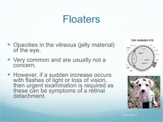Floaters Opacities in the vitreous (jelly material) of the eye. Very common and are usually not a concern. However, if a sudden increase occurs with flashes of light or loss of vision, then urgent examination is required as these can be symptoms of a retinal detachment. www.opto.ca 