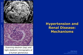Hypertension and Renal Disease: Mechanisms trc.ucdavis.edu/mjguinan/apc100/modules/ Urinary/mammal/cortex1/cortex.html trc.ucdavis.edu/mjguinan/apc100/modules/ Urinary/mammal/glomeruli0/glomeruli.html Scanning electron (top) and light (bottom) micrographs of a human glomerulus 