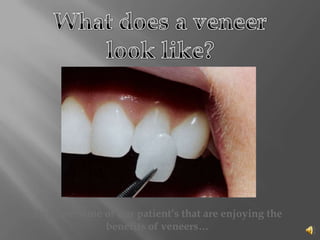 What does a veneer look like?Here are some of our patient’s that are enjoying the benefits of veneers…