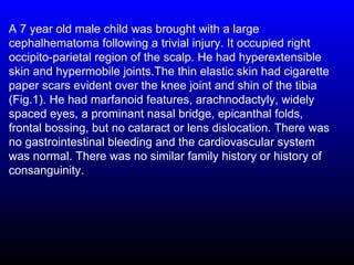 A 7 year old male child was brought with a large
cephalhematoma following a trivial injury. It occupied right
occipito-parietal region of the scalp. He had hyperextensible
skin and hypermobile joints.The thin elastic skin had cigarette
paper scars evident over the knee joint and shin of the tibia
(Fig.1). He had marfanoid features, arachnodactyly, widely
spaced eyes, a prominant nasal bridge, epicanthal folds,
frontal bossing, but no cataract or lens dislocation. There was
no gastrointestinal bleeding and the cardiovascular system
was normal. There was no similar family history or history of
consanguinity.
 