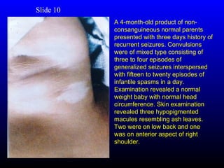 Slide 10
           A 4-month-old product of non-
           consanguineous normal parents
           presented with three days history of
           recurrent seizures. Convulsions
           were of mixed type consisting of
           three to four episodes of
           generalized seizures interspersed
           with fifteen to twenty episodes of
           infantile spasms in a day.
           Examination revealed a normal
           weight baby with normal head
           circumference. Skin examination
           revealed three hypopigmented
           macules resembling ash leaves.
           Two were on low back and one
           was on anterior aspect of right
           shoulder.
 