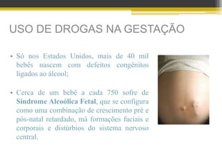 USO DE DROGAS NA GESTAÇÃO
• Só nos Estados Unidos, mais de 40 mil
bebês nascem com defeitos congênitos
ligados ao álcool;
• Cerca de um bebê a cada 750 sofre de
Síndrome Alcoólica Fetal, que se configura
como uma combinação de crescimento pré e
pós-natal retardado, má formações faciais e
corporais e distúrbios do sistema nervoso
central.
 