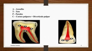 Jonathan Cardoso 3
A – Assoalho
T – Teto
P – Paredes
C – Cornos pulpares = Divertículo pulpar
 