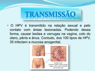 TIPOS MAIS COMUNSO HPV–6 e O HPV–11são exemplos de HPV que causam apenas verrugas.Porém, existem outros tipos de HPV conhecidos como oncogênicos, ou seja, de alto risco, como o HPV-16, 18, 31 e 45, sendo estes, responsáveis por mais de 80%  dos casos de câncer do colo do útero, quando não tratados.