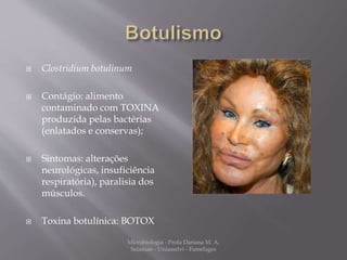  Clostridium botulinum 
 Contágio: alimento 
contaminado com TOXINA 
produzida pelas bactérias 
(enlatados e conservas); 
 Sintomas: alterações 
neurológicas, insuficiência 
respiratória), paralisia dos 
músculos. 
 Toxina botulínica: BOTOX 
Microbiologia - Profa Dariana M. A. 
Salaman - Uniasselvi - Famelages 
 