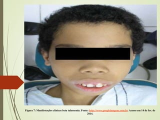 Figura 7: Manifestações clínicas beta talassemia. Fonte: http://www.googleimagens.com.br. Acesso em 14 de fev. de
2014.

 